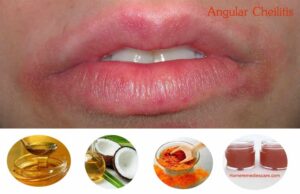 18 Natural Home Remedies To Treat Angular Cheilitis