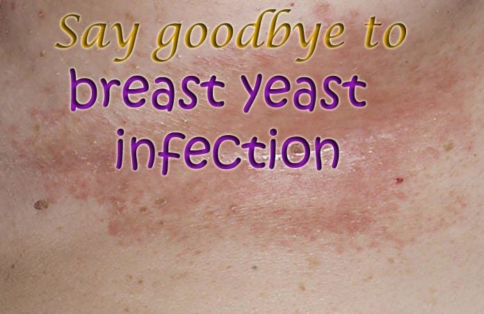 Get Rid of Yeast Infection Under Breast